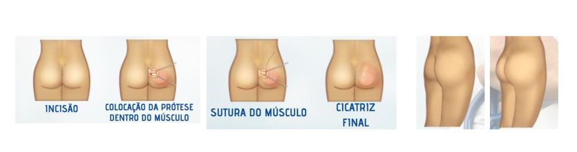 prótese de glúteos