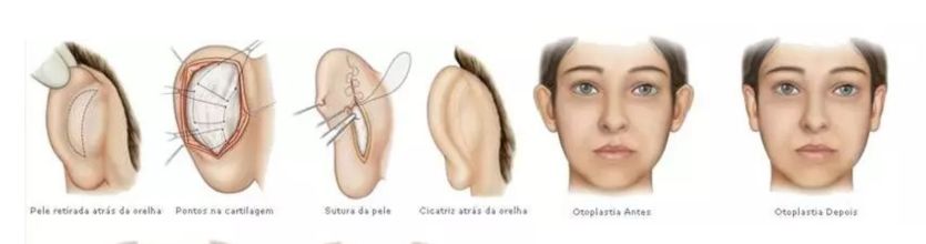 otoplastia e lobuloplastia