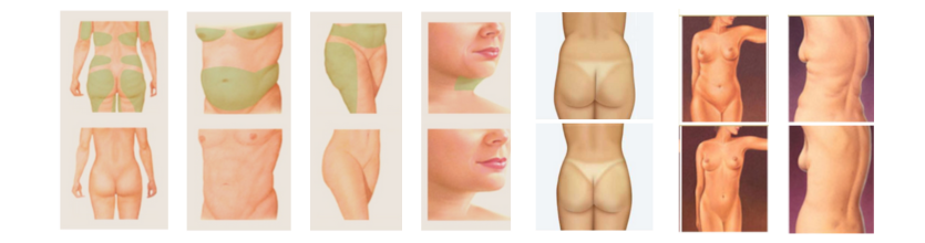 Endolaser X Hidrolipo