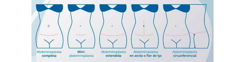 abdominoplastia