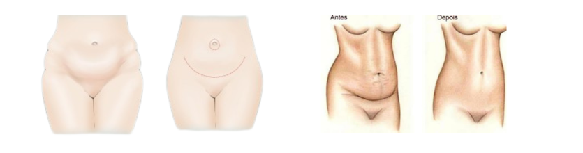 abdominoplastia